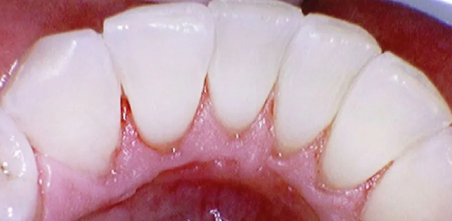 Teeth-Cleaning-BA-02