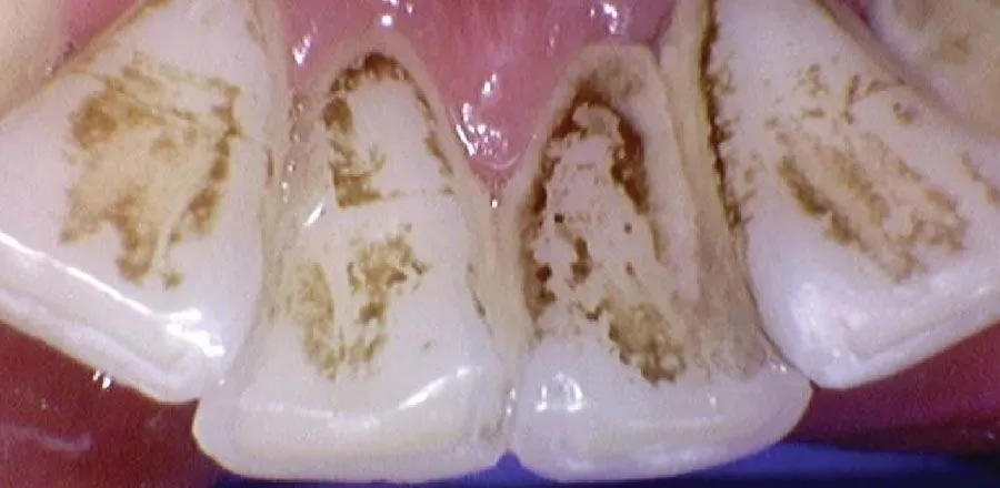Teeth-Cleaning-BA-03