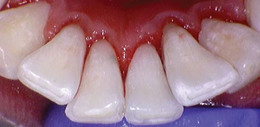 Teeth-Cleaning-BA-04