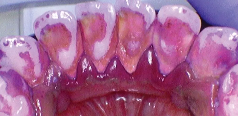 Teeth-Cleaning-BA-05