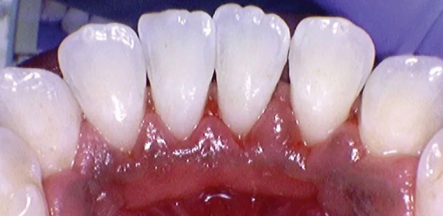Teeth-Cleaning-BA-06