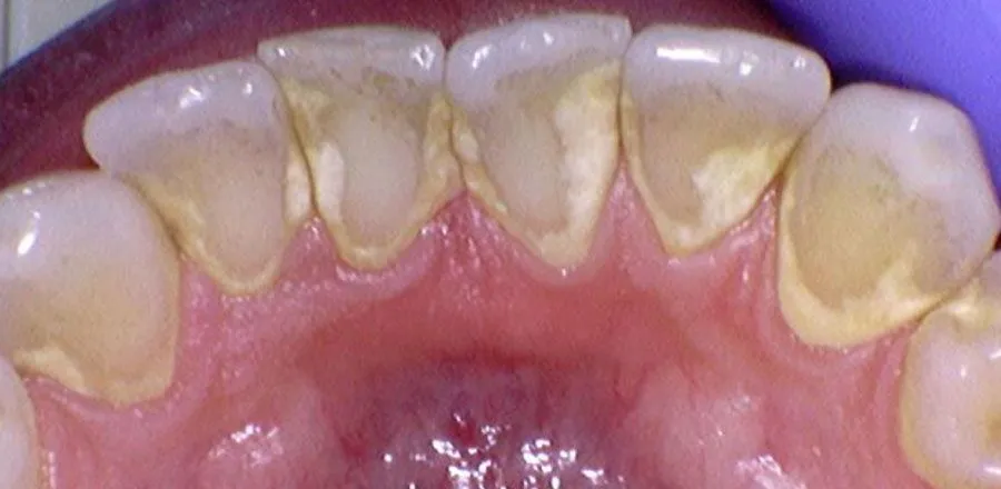 Teeth-Cleaning-BA-07