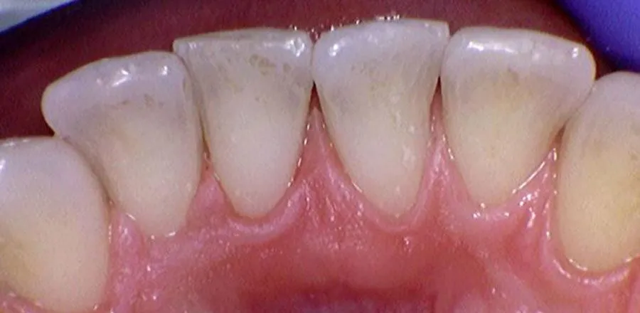 Teeth-Cleaning-BA-08