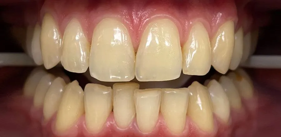 Teeth-Whitening-BA-01