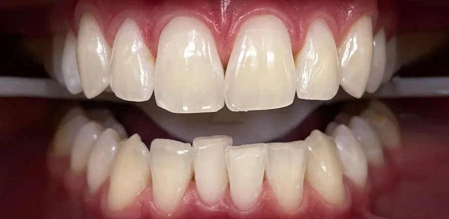 Teeth-Whitening-BA-02