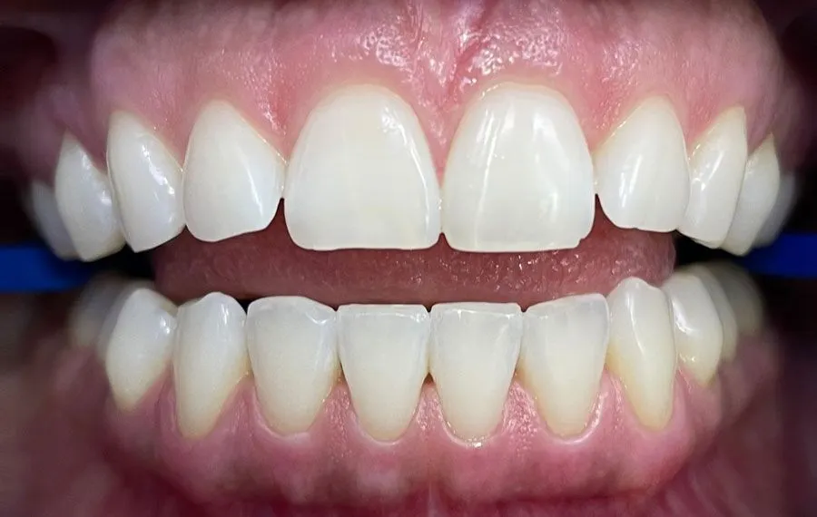 Teeth-Whitening-BA-04