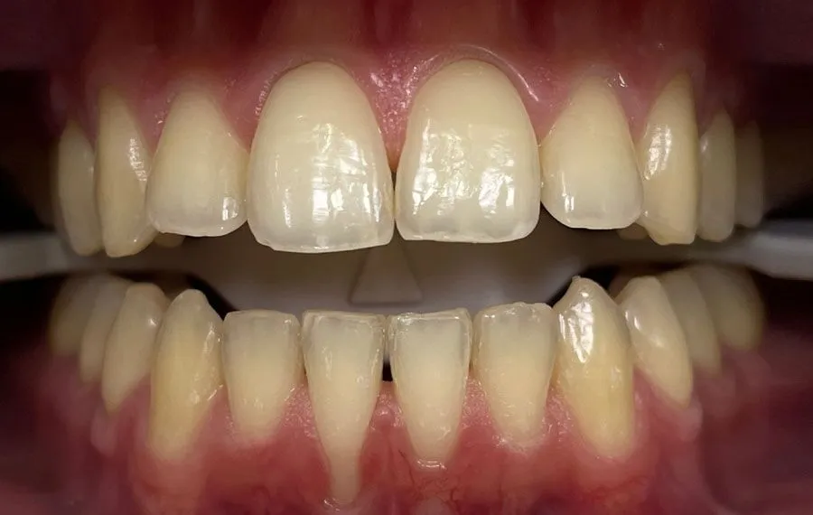 Teeth-Whitening-BA-05