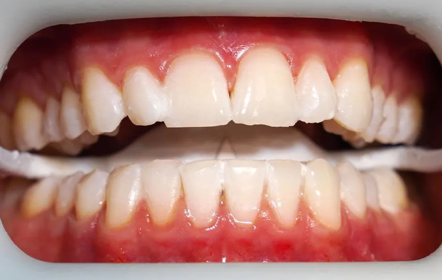Teeth-Whitening-BA-08-1