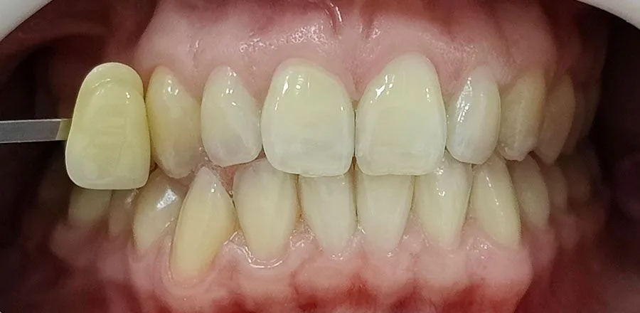 Teeth-Whitening-BA-09
