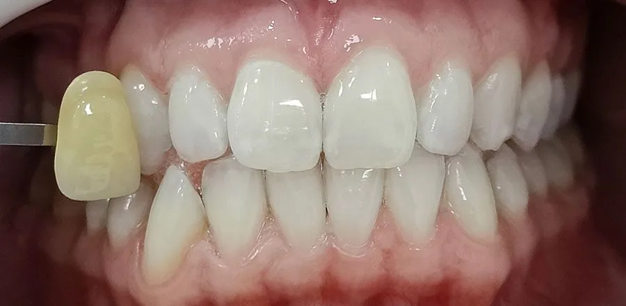 Teeth-Whitening-BA-10