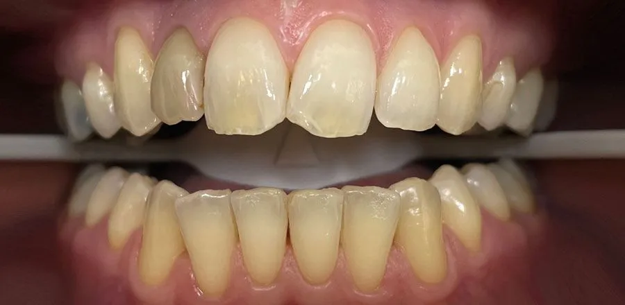 Teeth-Whitening-BA-11