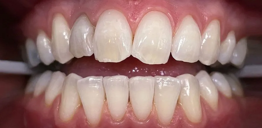 Teeth-Whitening-BA-12