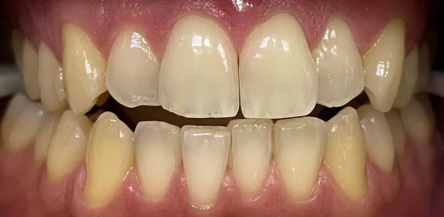 Teeth-Whitening-BA-13