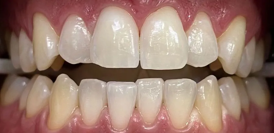 Teeth-Whitening-BA-14