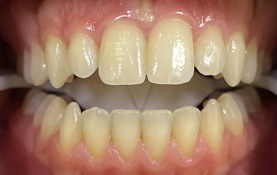 Teeth-Whitening-BA-15
