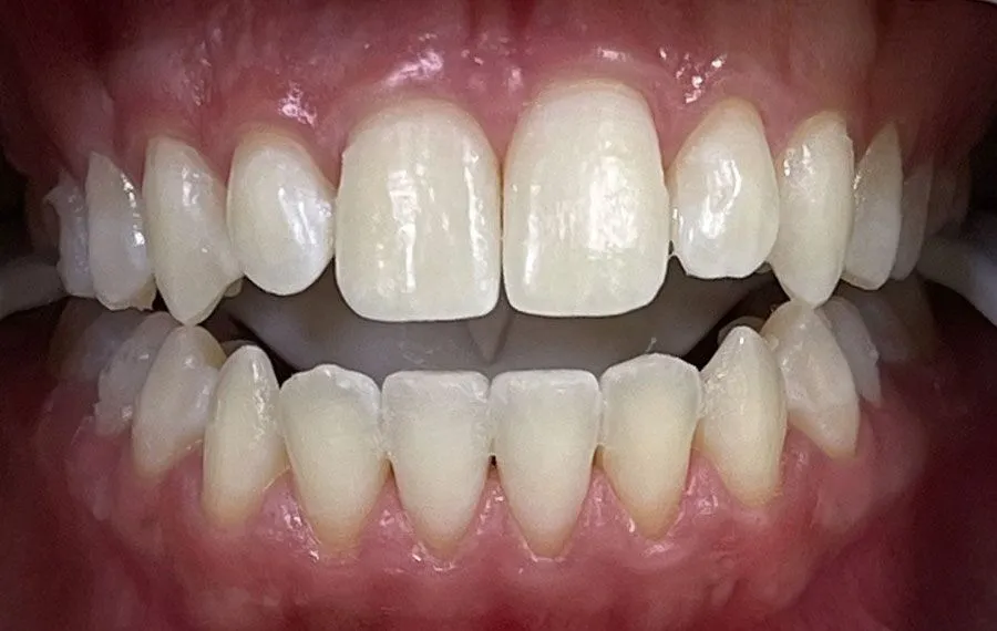 Teeth-Whitening-BA-16