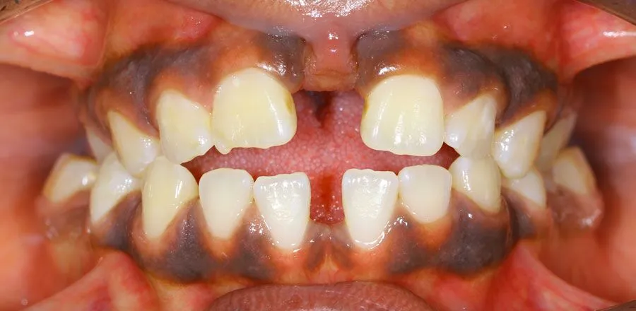 dental-braces-BA-05 (1)