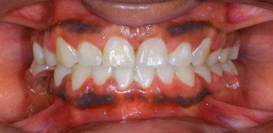 dental-braces-BA-06 (1)
