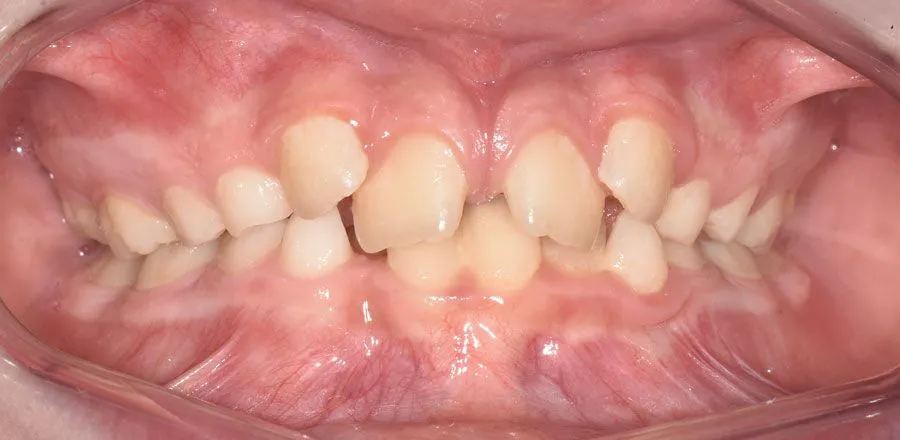 dental-braces-BA-07