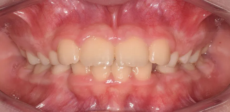 dental-braces-BA-08