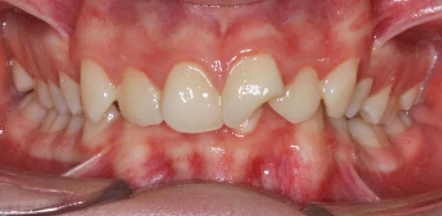 dental-braces-BA-09