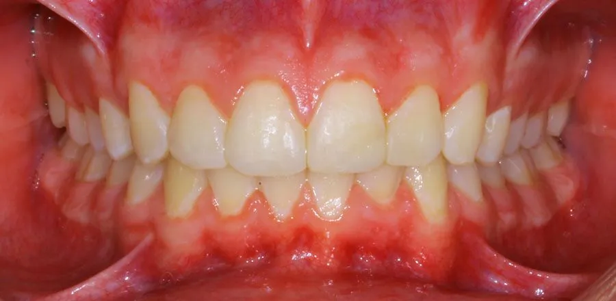 dental-braces-BA-10