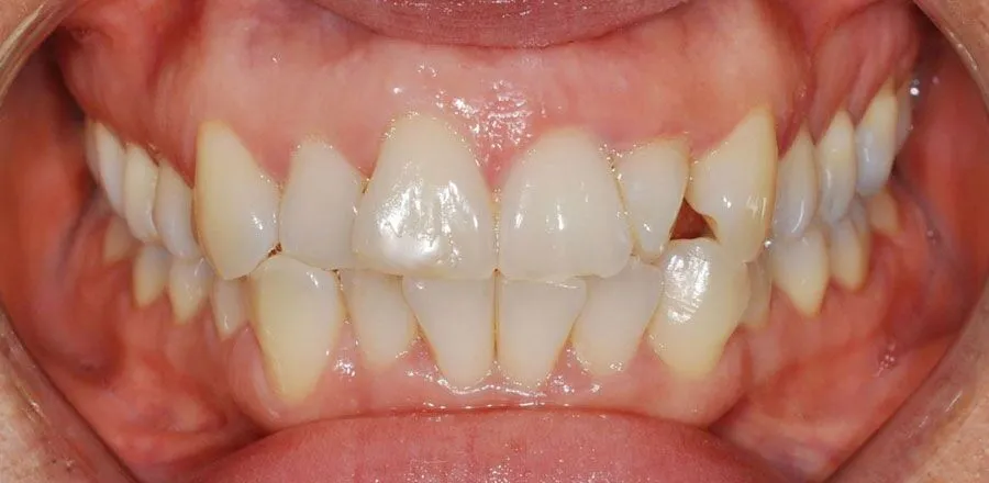 dental-braces-BA-13