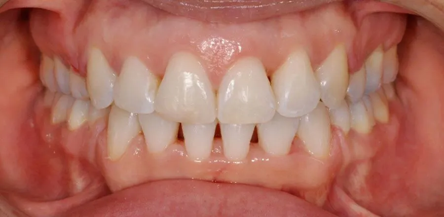 dental-braces-BA-14