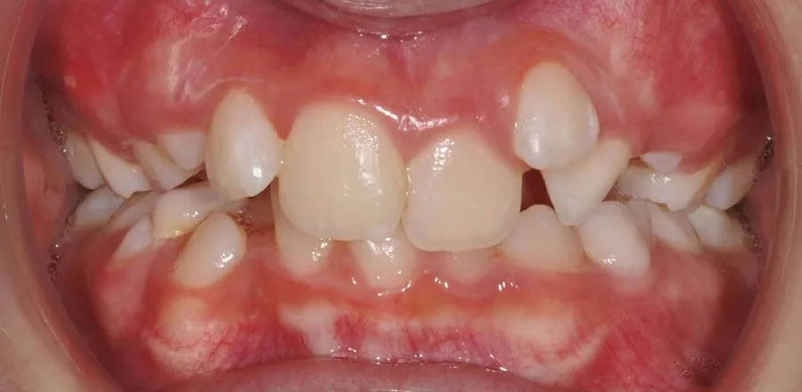 dental-braces-BA-15
