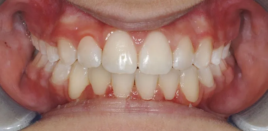 dental-braces-BA-16