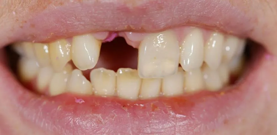 dental-implant-BA-01