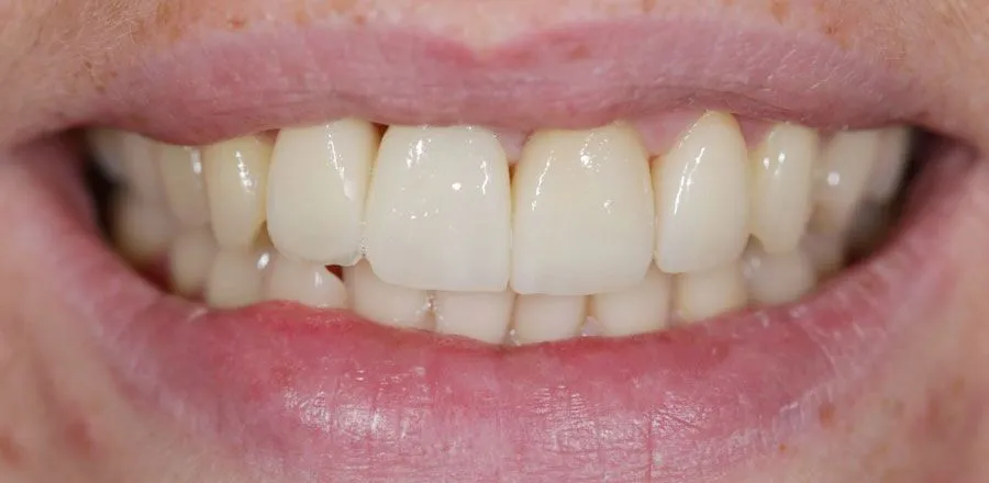 dental-implant-BA-02