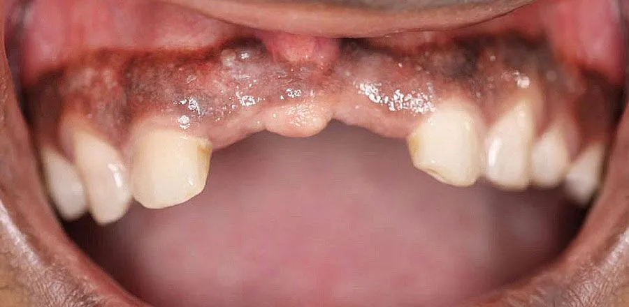 dental-implant-BA-03