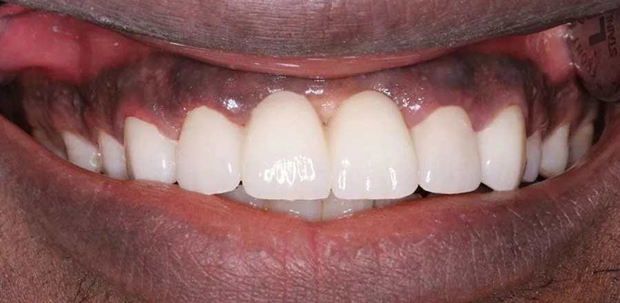 dental-implant-BA-04