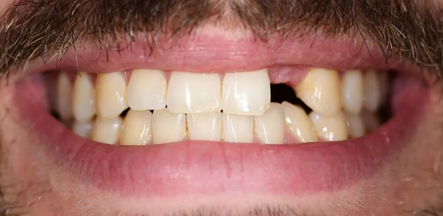 dental-implant-BA-05