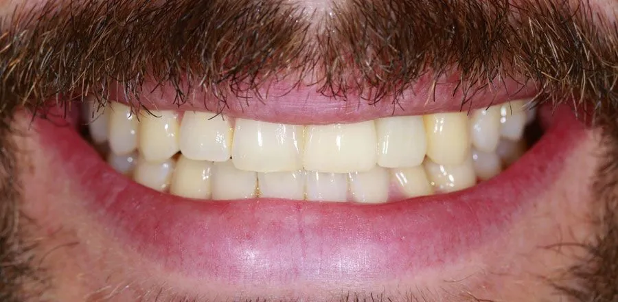 dental-implant-BA-06