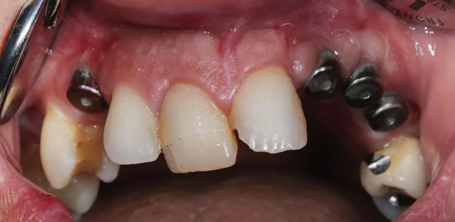 dental-implant-BA-07