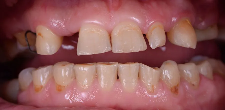 dental-implant-BA-09