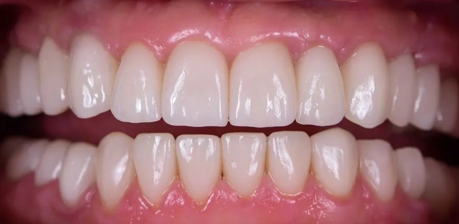 dental-implant-BA-10