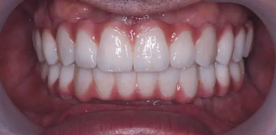dental-implant-BA-12