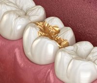 gold dental filling